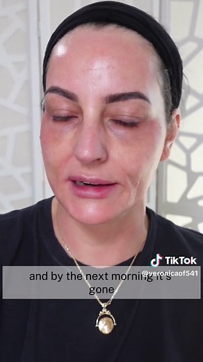 Beginners Tutorial For Microneedling With A Stamping Device