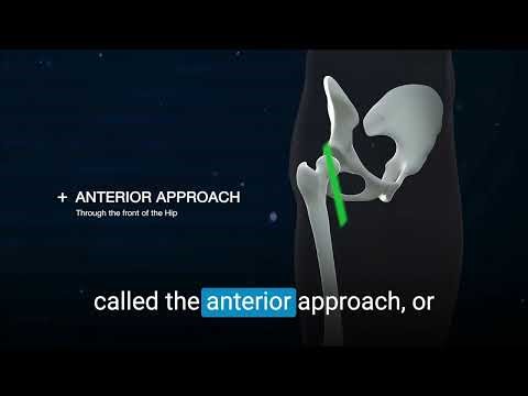 Hip Replacement Approaches Explained by Dr. Amit Atrey