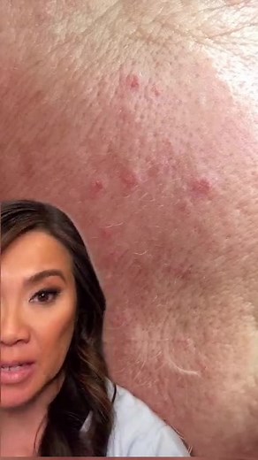 Sandra Lee, MD, FAAD, FAACS | Got those little bumps that just won’t budge? 🤔 It could be sebaceous hyperplasia. Here’s what it is and what to do about it 👇✨ #DermTips... | Instagram