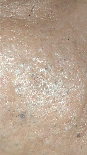 sac be spa blackhead elderly men face | sac be spa men face information | new sac be spa #360