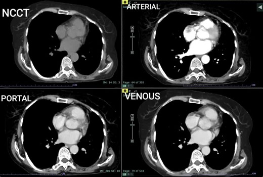 Understanding CT Triple-Phase Scan for Liver Evaluation | SUHAIL . posted on the topic | LinkedIn