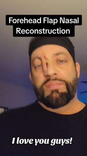 Forehead Flap Nasal Reconstruction Journey