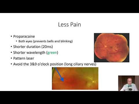 Panretinal Photocoagulation (PRP) Basics Lumenis Laser - BIDMC - Jamie Raevis, Arroyo, Gonzalez