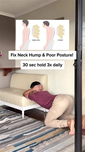 Neck Hump & Poor Posture Correction Stretch!! #posture #physicaltherapy