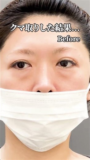 [Late 40s] Dark circle removal + fat injection completely transformed my eyes! So beautiful! #Ant...