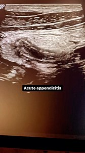 223K views · 656 reactions | Appendix #appendicitis #acutappendicitis #appendixultrasound #abdominalultrasound #ultrasonography #radiologyresident #ultrasoundmadeeasy | Ultrasound made easy | Facebook
