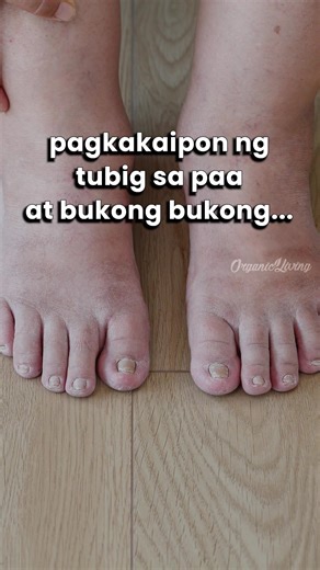 Natural na solusyon sa namamagang paa