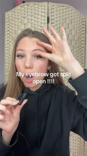 My eyebrow got split open !!!!!