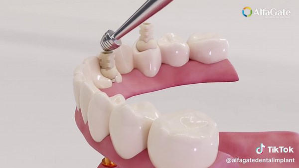 Impression Techniques for Implant Dentistry - | step by step | Multi-unit open tray Impression technique #ftypシ #dentalimplants #dentistryworld #alfagate #dentists #innovation