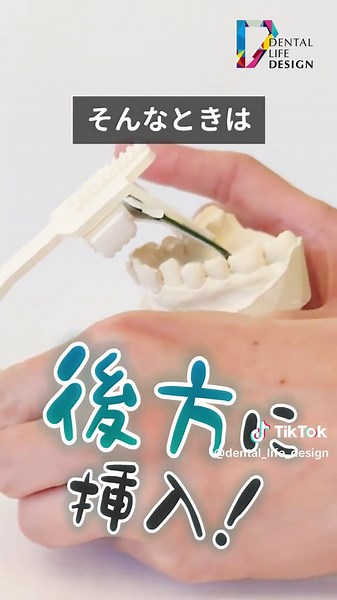 V字歯列弓患者のデンタル撮影ポイント