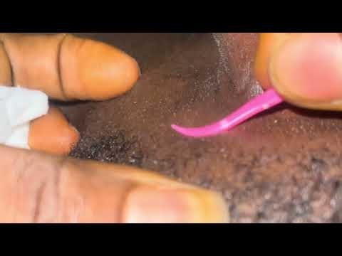 ASMR 🦋 Pimple Popping 😳🔥 | The Most Satisfying Extractions You’ll See