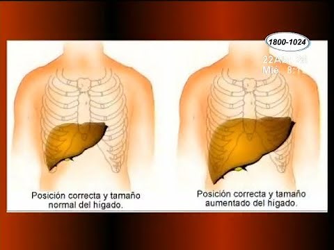 Salud: ¿Qué es la hepatomegalia?