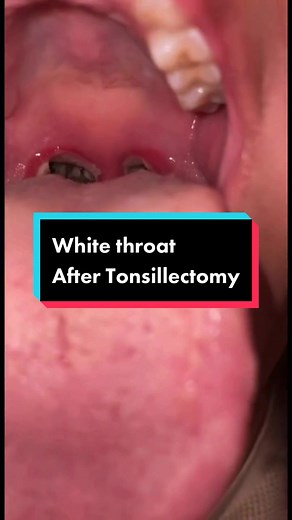What to Expect After Tonsillectomy: Coughing Up Mucus