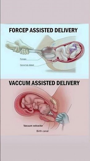 Forceps vs. Vacuum: The Breakdown 🔍 #baby #pregnancybyfaith #baby #love #like #foryou