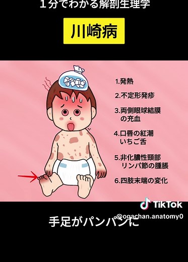 川崎病の症状とその早期治療