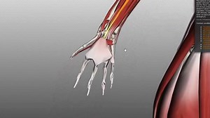 Volkmann's Contracture