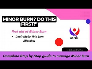 How to Treat a Minor Burn at Home | First Aid Tips
