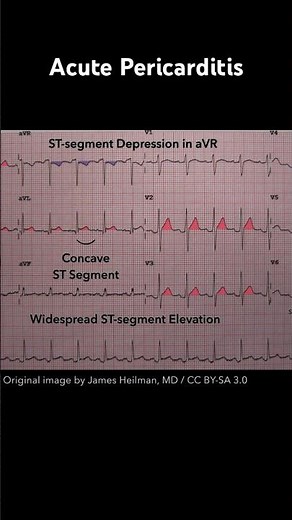 Acute Pericarditis ECG: ST-segment depression in aVR