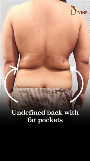 Back Fat Removal with Vaser Lipo | Back Contouring with VASER Liposuction Before & After