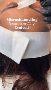 procell microchanneling is like microneedling’s smarter, more evolved sibling. here’s why: ✅smaller, more precise channels - unlike traditional microneedling, procell creates uniform micro-channels that trigger collagen without excessive damage or downtime. ✅stem cell technology procell uses growth-factor serums derived from bone marrow stem cells, which are clinically proven to speed up healing and maximize skin regeneration. ✅less inflammation, better results - traditional microneedling can cr