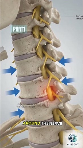 What Cervical Spondylosis Does to Your Neck - Part 1 #lowerbackpain #anatomy