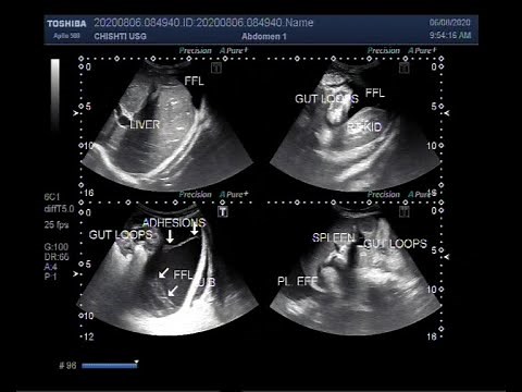 Ultrasound Video showing Adhesions in between in gut loops and abdominal organs.