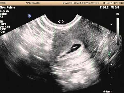 Sono HSG Procedure with ABBI showing right tube