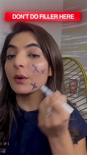 ✨ Fuller Face? This Is What Not to Do ✨ If you already have a fuller face, adding filler to the wrong areas can actually make you look bulkier, not slimmer. ✔️ Avoid placing filler in areas that add width ✔️ Focus on the chin and jawline to create length ✔️ Add subtle support to the lateral cheeks for lift ✔️ Enhancing structure creates a slimmer, more sculpted look The key to facial balancing isn’t adding volume everywhere — it’s placing filler strategically to elongate, lift, and define. When 