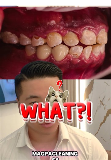 Dental Cleaning Process Explained