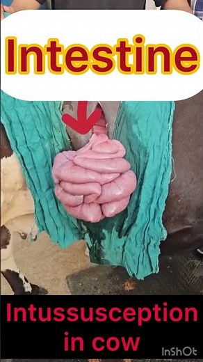 Intussusception l Intestine l dr Umar khan