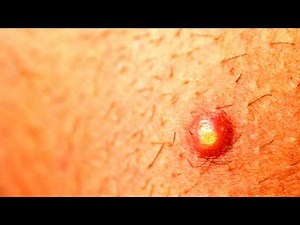 Furoncle / Boil (Galerie photo / Photo gallery)