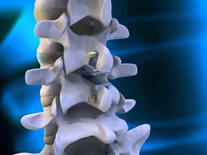 The coflex-F® Implanted | Paradigm Spine | Spinal Procedures