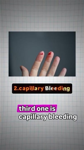 Types of Bleeding (3/365day)