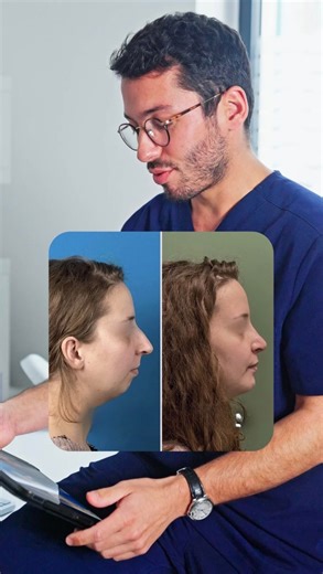 Dr Pierre Gagnieur | Rhinoplastie Marseille on Instagram: "Cas d’une patiente de 28 ans présentant une bosse hyperprojetée, une pointe tombante et un menton très fuyant responsable d’un double menton. 🦷 Étape 1 : chirurgie orthognathique Avancée des deux mâchoires pour redonner du volume, corriger la rétrogénie et redessiner l’angle cervico-mentonnier. 👃 Étape 2 : rhinoplastie 6 mois plus tard Bosse supprimée, pointe relevée, nez raccourci pour un profil harmonisé. ✨ Un résultat naturel qui l’