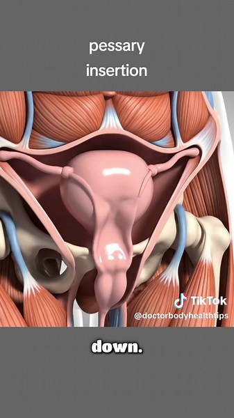 Uterus Prolapse Treatment Without Surgery | Pessary Ring Explained Simply (3D animation) #uterusprolapse #pelvicorganprolapse #pessary #pessaryring #pessaryinsertion
