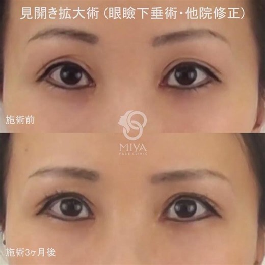 見開き拡大術（眼瞼下垂術・他院修正）の症例 / MIYAフェイスクリニック #美容 #美容整形 #眼瞼下垂