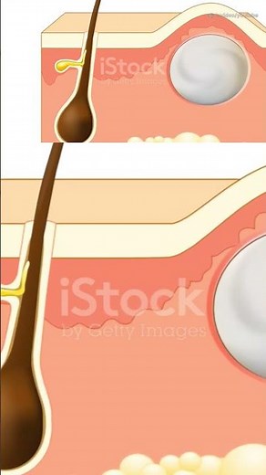 Understanding Sebaceous Cysts: Causes, Symptoms, and Treatment #sebaceouscyst