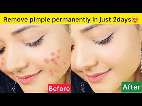 Remove pimple and spots permanently in just 2 days😍❤️ | Natural Ingredients ✅ | #pimplefreeface
