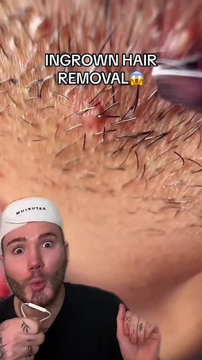 Ingrown Hair Removal: Satisfying & Gross!