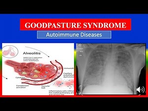 GOODPASTURE SYNDROME - Definition, types, causes, pathophysiology, signs & symptoms, medicine