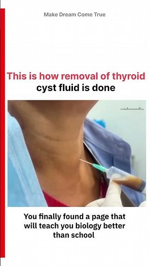 🧪This is how removal of thyroid 💉 cyst fluid is done 🩺| MDCT