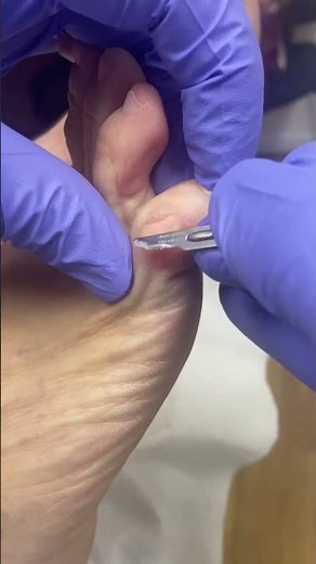 Satisfying Little Toe Callus & Corn Removal by Podiatrist #FootCare #PodiatrySatisfaction