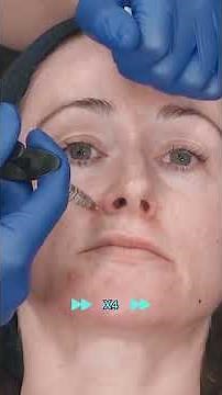 Treating Maxillary Recession with Pyriform Fossa Filler 💎 GEM© Clinic Evidence-Based Techniques