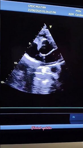 Bicuspid aortic valve #cardiology #echo #heartdisease #heartvalve