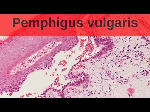 Pemphigus Vulgaris - Pathology mini tutorial