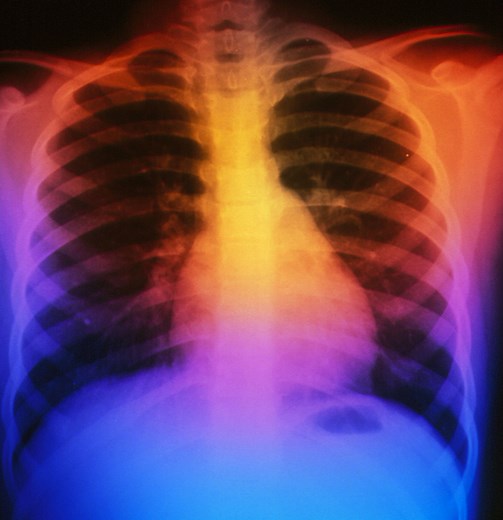 How to Tell if Your Ribs Are Bruised or Broken