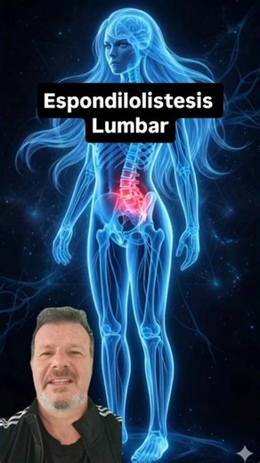 ESPONDILOLISTESIS LUMBAR