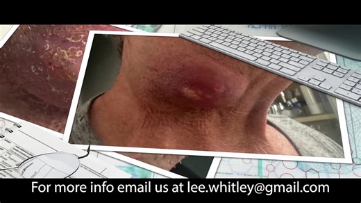 How i used Cannabis Oil to beat cancer and helped 2000+ others do the same!