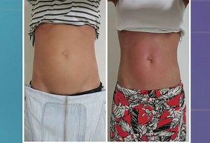 ¿Qué es la diástasis abdominal y cómo se trata? | Teletica