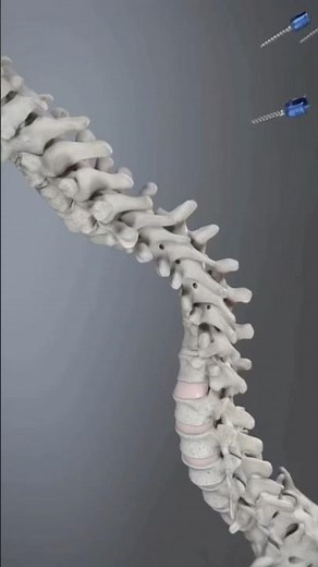 Spinal fixation system #spinehealth #spinel #spine
